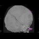 Fissure of skull, pneumocephalus, contusion: CT - Computed tomography